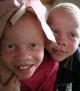 La caza de albinos en África (TV)