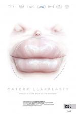 Caterpillarplasty (S)